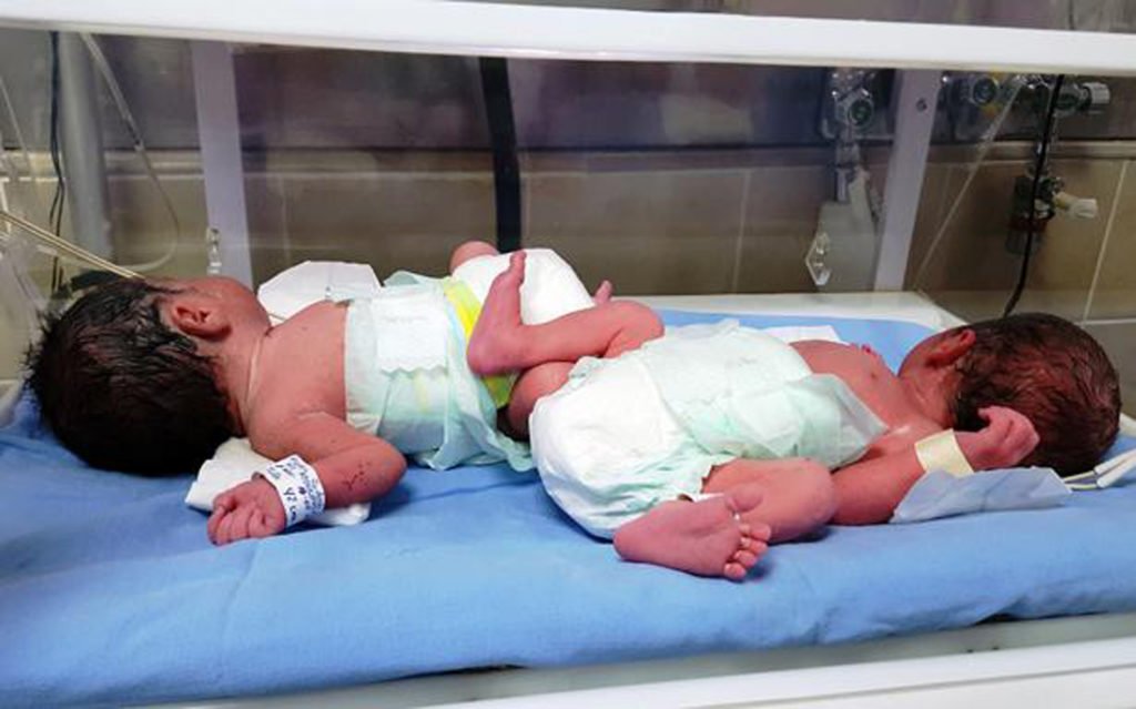 بھارت : مرد نے دو بچوں کو جنم دیکر دنیا کو حیران اور ڈاکٹرز کو پریشان کر دیا
