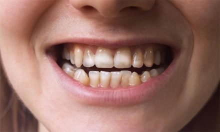 دانتوں پر ایسی نشانات کس مرض کی نشانی ہے،ماہرین کا اہم انکشاف